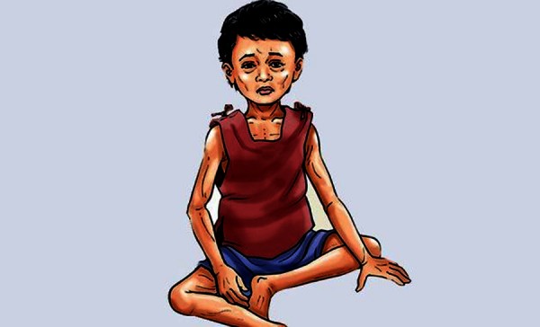 बालबालिकामा कुपोषण बढ्यो