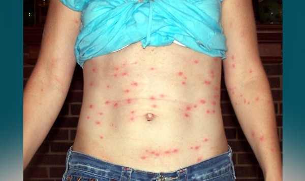 चितवनमा दुई सय ४६ जनामा स्क्रब टाइफसको सङ्क्रमण