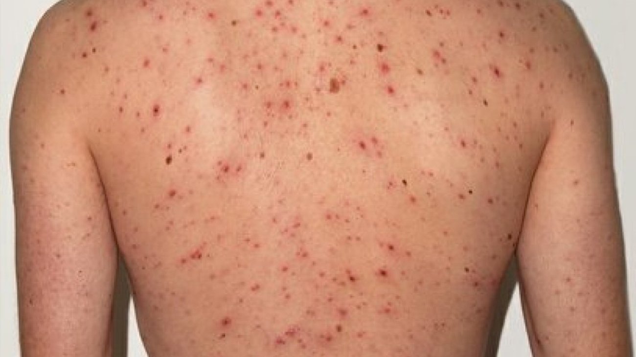 ढोरपाटनमा थप दुई जनामा दादुरा सङ्क्रमण पुष्टि