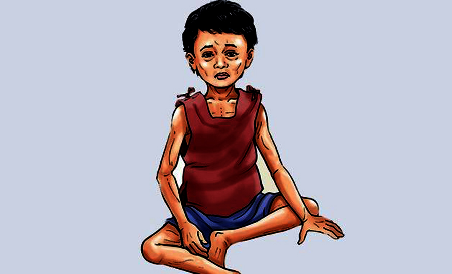 बालबालिकामा कुपोषण बढ्यो